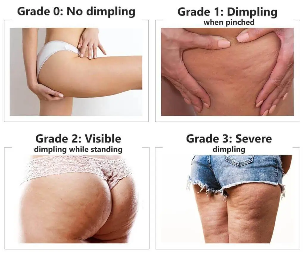 Representation of the stages of cellulite development Shoreham-by-Sea