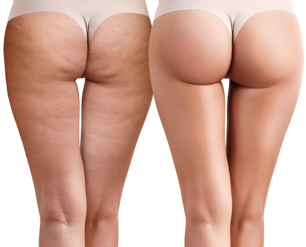 Read about cellulite Shoreham-by-Sea: causes, treatments, and debunked myths